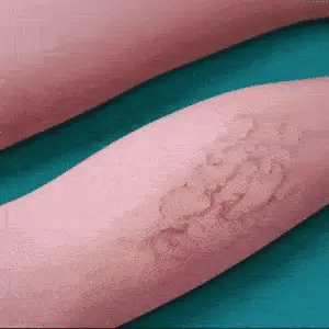 Sprej za Proširene Vene